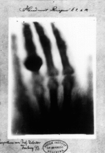 First medical X-ray by Wilhelm Röntgen of his wife Anna Bertha Ludwig's hand.
